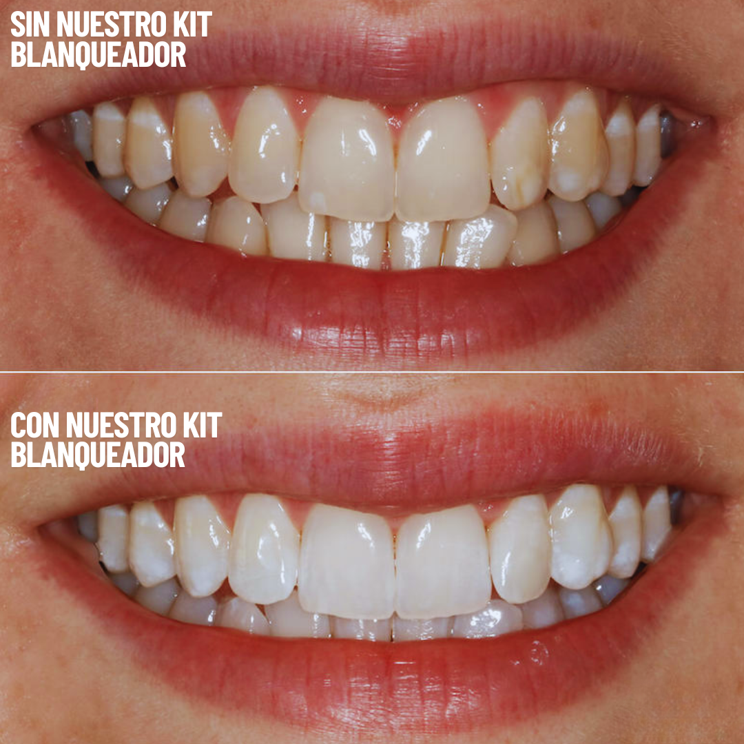 KIT BLANQUEADOR DENTAL + VITAMINA E